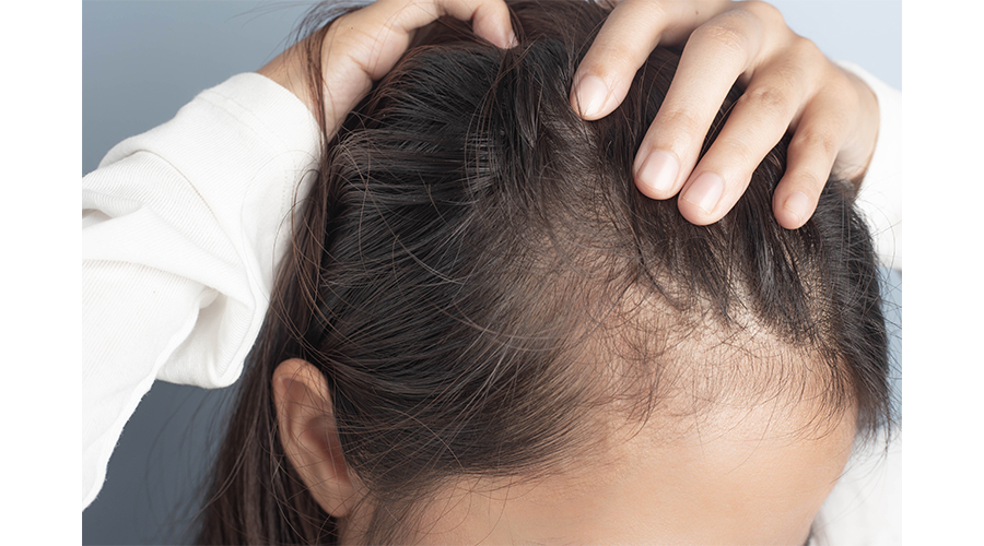Hair Loss 101: When to Consider a Blood Test and What to Expect